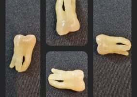 Imagem do dente siso, de 3 raízes, extraído da boca da Selma devido ao bruxismo.