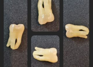 Imagem do dente siso, de 3 raízes, extraído da boca da Selma devido ao bruxismo.